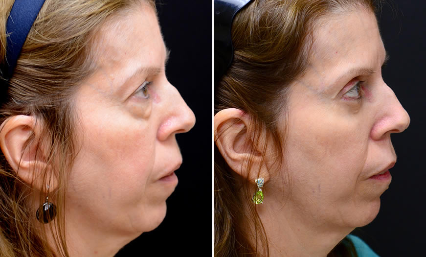 Canthoplasty & Canthopexy Surgery Results In New Jersey Right View