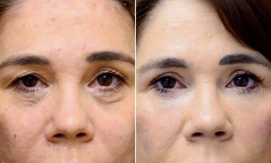 Canthoplasty & Canthopexy Surgery Results In NJ