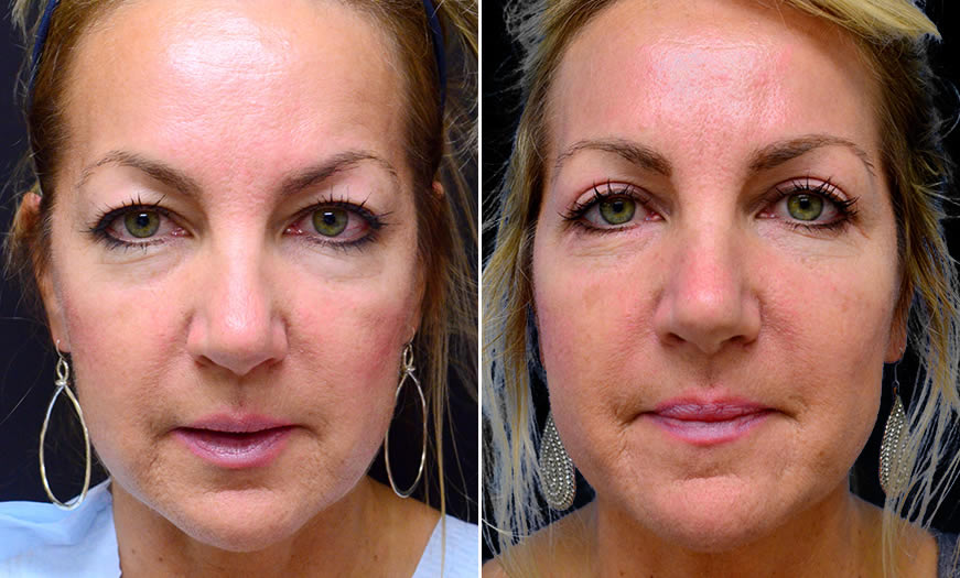 Canthoplasty And Canthopexy Surgery Results