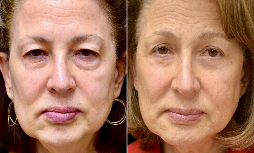 Canthoplasty & Canthopexy Surgical Results In New Jersey