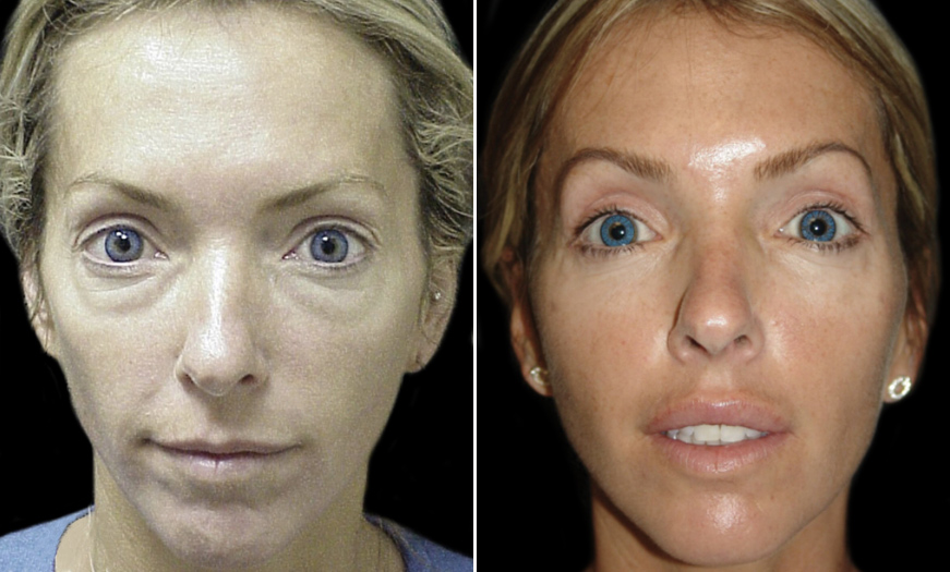 Canthopexy & Canthoplasty Before & After