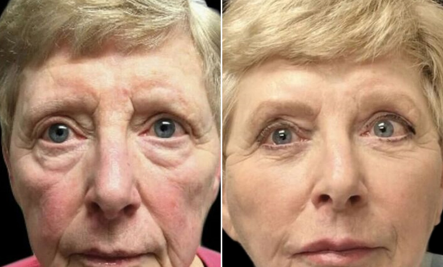 Canthopexy & Canthoplasty Before & After In NJ