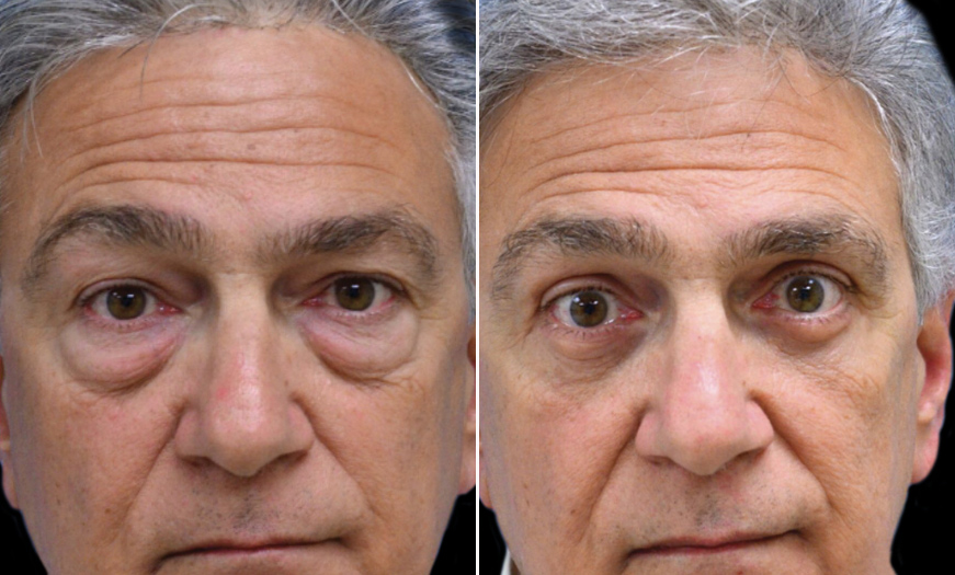 Canthopexy & Canthoplasty Before & After NJ