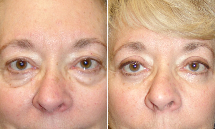 Canthopexy & Canthoplasty Before & After New Jersey