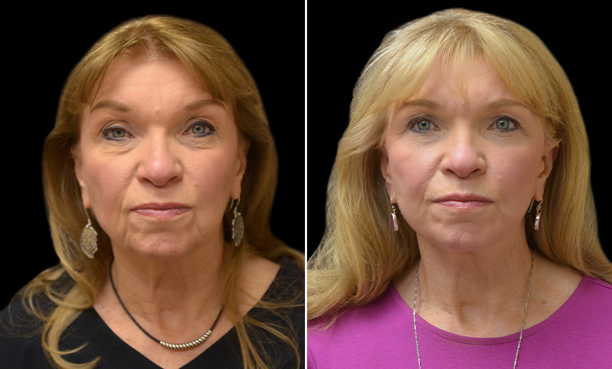 Canthopexy & Canthoplasty Surgery Results