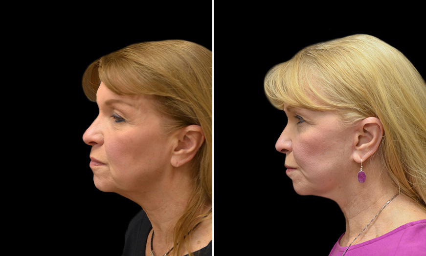 Canthopexy & Canthoplasty Surgery Results Left View