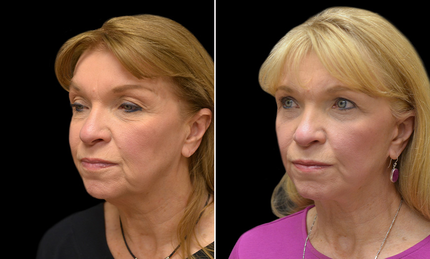 Canthopexy & Canthoplasty Surgery Results ¾ Left View