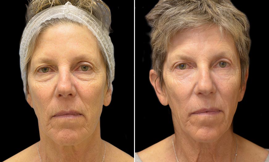 Canthopexy & Canthoplasty Surgery Results NJ