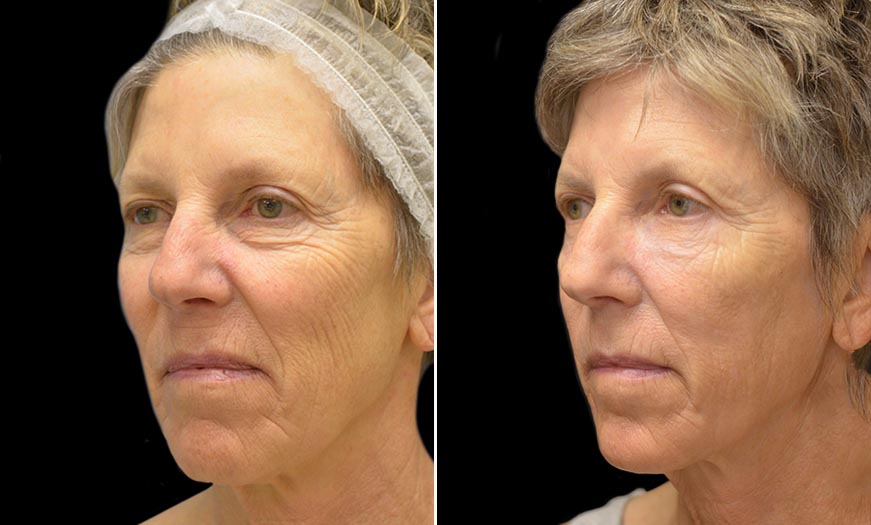 Canthopexy & Canthoplasty Surgery Results NJ  ¾ Left View