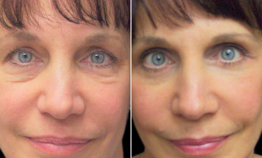 Canthopexy & Canthoplasty Surgery Results In New Jersey