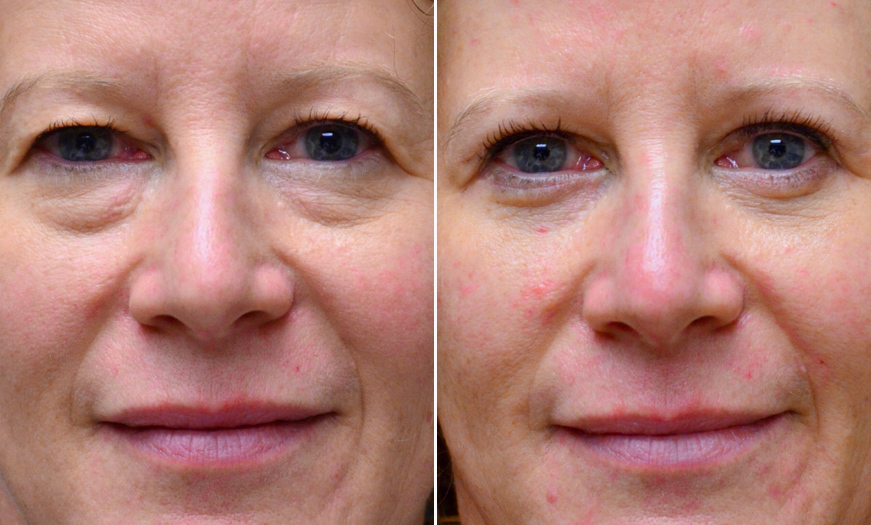 Canthopexy & Canthoplasty Surgery Results New Jersey