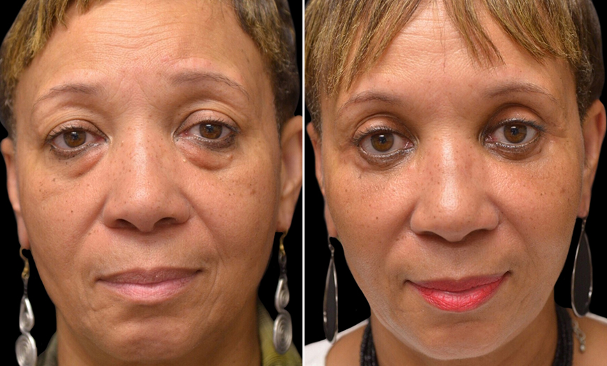 Canthopexy And Canthoplasty Results