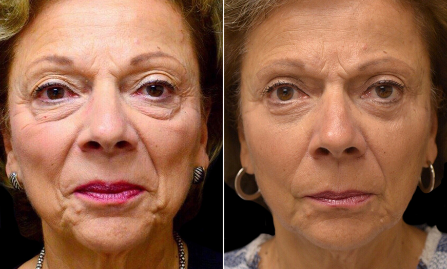 Canthopexy And Canthoplasty Results NJ