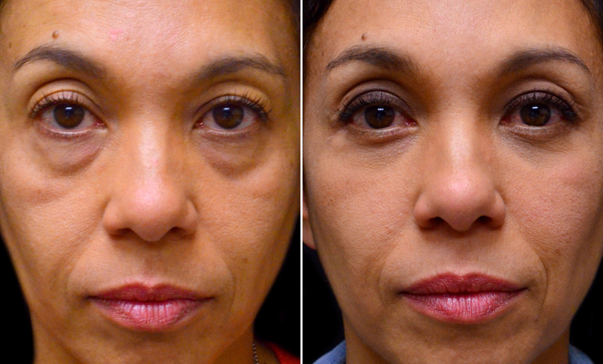 Canthopexy And Canthoplasty Results In NJ