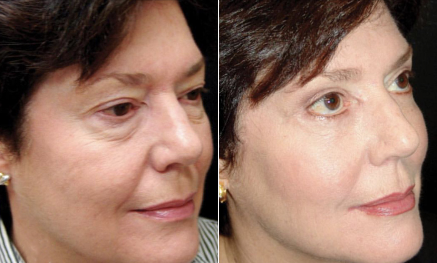 Canthopexy And Canthoplasty Results New Jersey