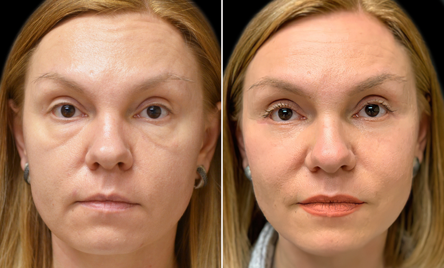 Canthopexy And Canthoplasty Results In New Jersey