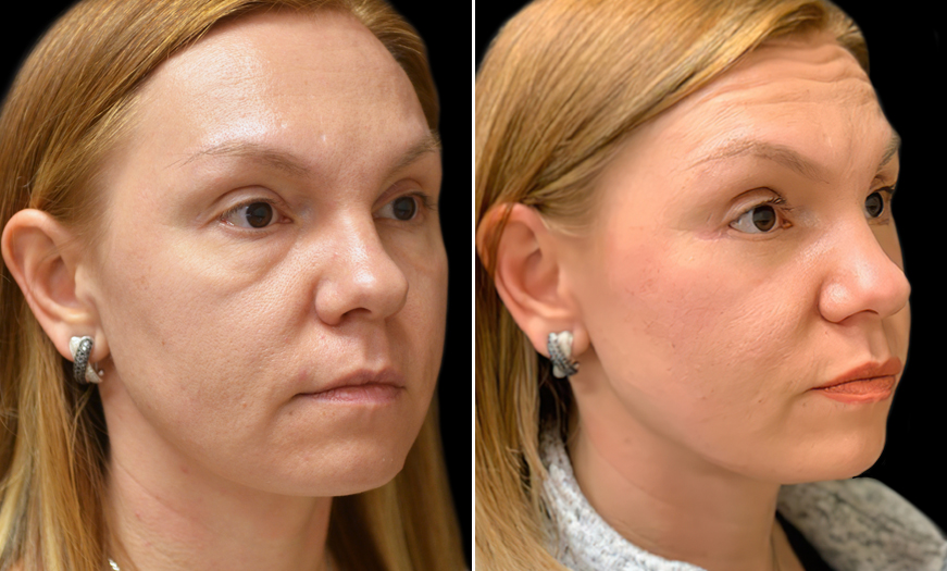 Canthopexy And Canthoplasty Results In New Jersey ¾ Right View