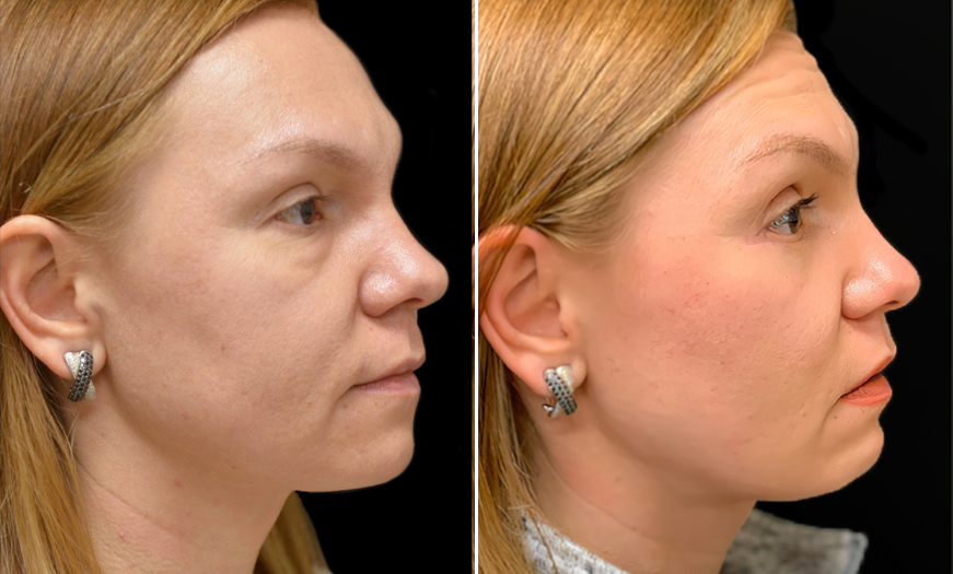 Canthopexy And Canthoplasty Results In New Jersey  Right View