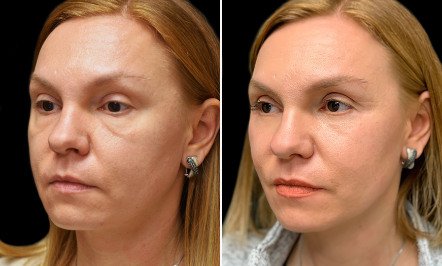 Canthopexy And Canthoplasty Results In New Jersey  ¾ Left View