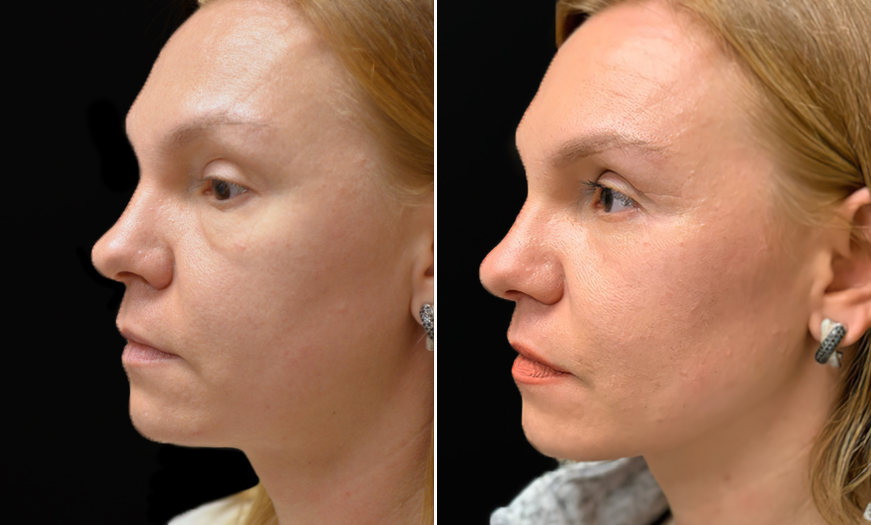 Canthopexy And Canthoplasty Results In New Jersey  Left View