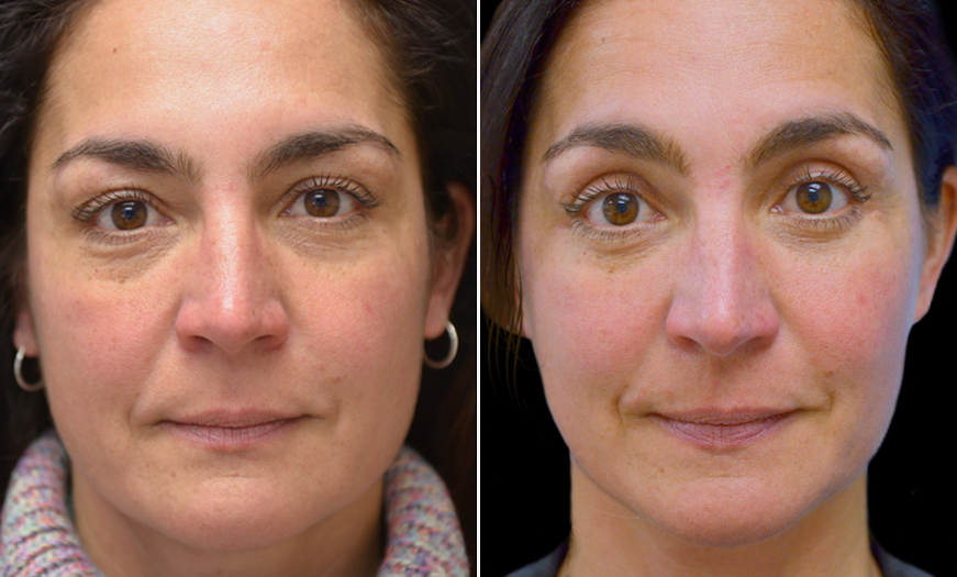 Canthopexy & Canthoplasty Surgery Results In NJ