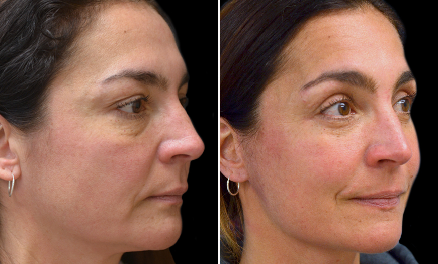 Canthopexy & Canthoplasty Surgery results In NJ ¾ Right View