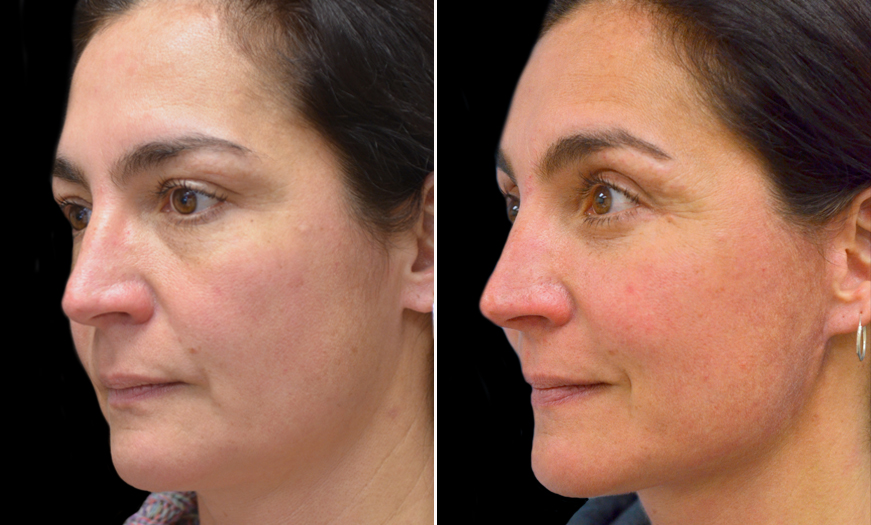 Canthopexy & Canthoplasty Surgery results In NJ ¾ Left View 