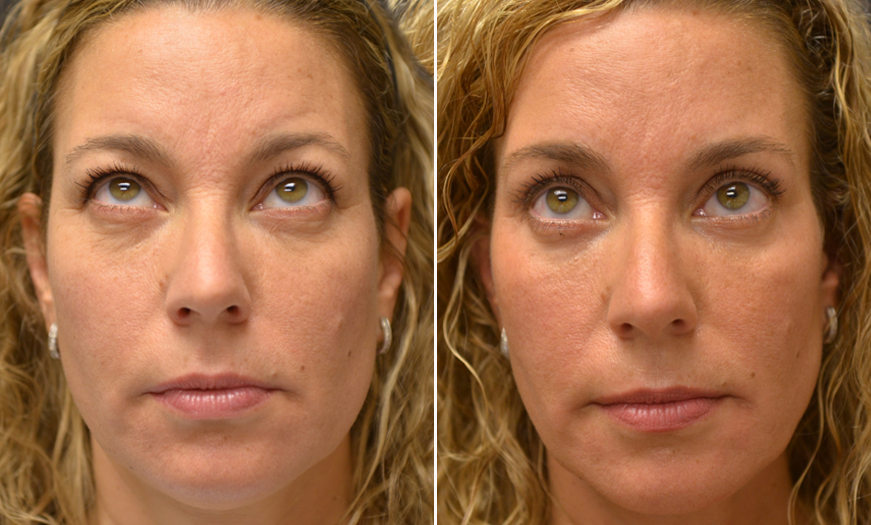 Surgical Results For Canthopexy & Canthoplasty