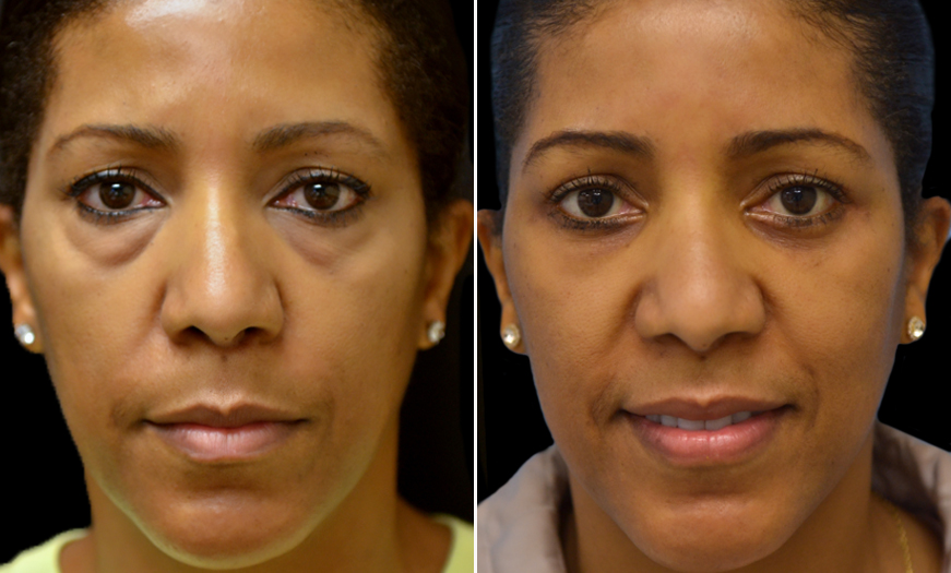 Surgical Results For Canthopexy & Canthoplasty NJ