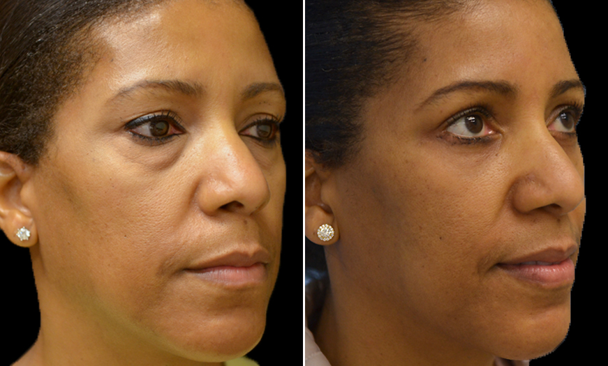 Surgical Results For Canthopexy & Canthoplasty NJ ¾ Right View