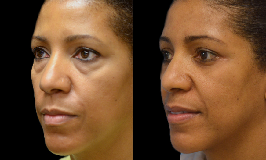 Surgical Results For Canthopexy & Canthoplasty NJ ¾ Left View