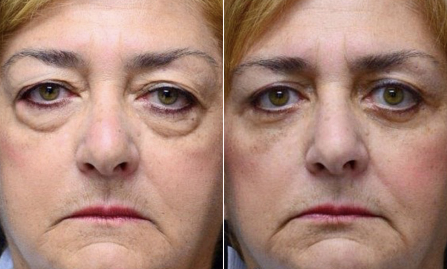 Surgical Results For Canthopexy & Canthoplasty In NJ